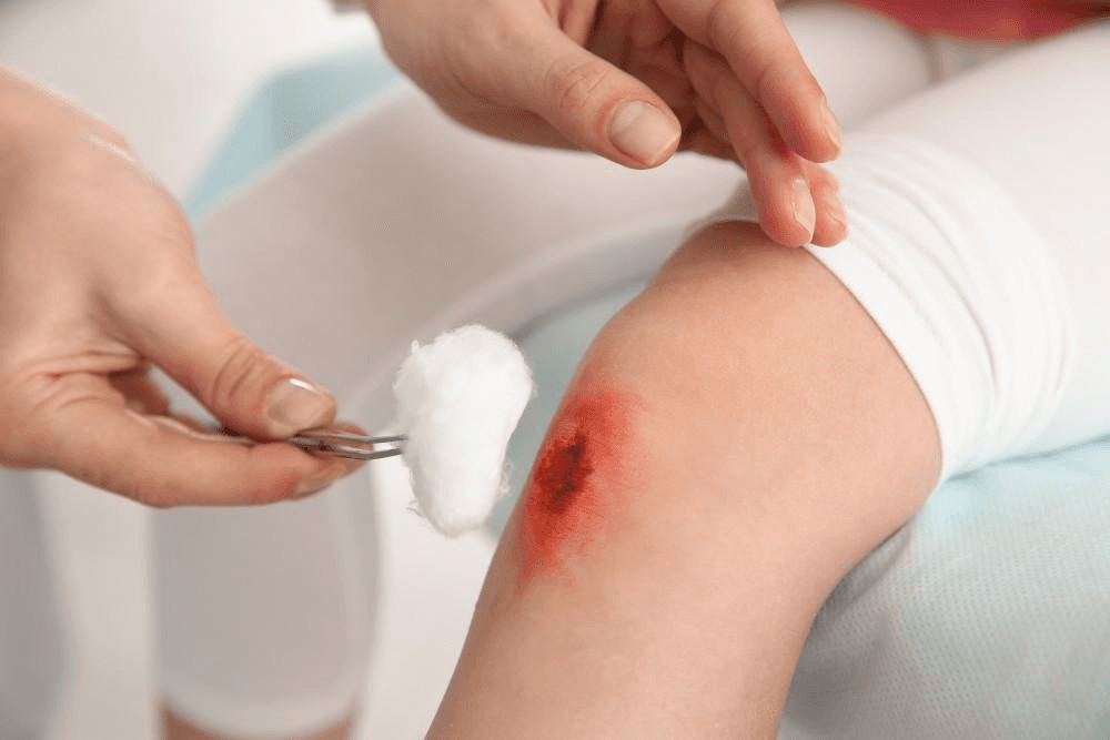 Healthcare provider treating a wound on a knee with cotton and tweezers